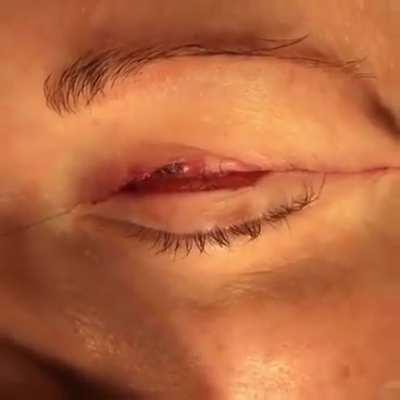 Closing and tightening an upper eyelid incision with a suture during a blepharoplasty procedure!