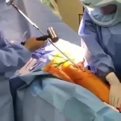 The skilled work of an orthopedic surgeon removing a metal rod from a patient's bone. The procedure showcases the extraction of a tibial intramedullary rod, also known as an IM nail