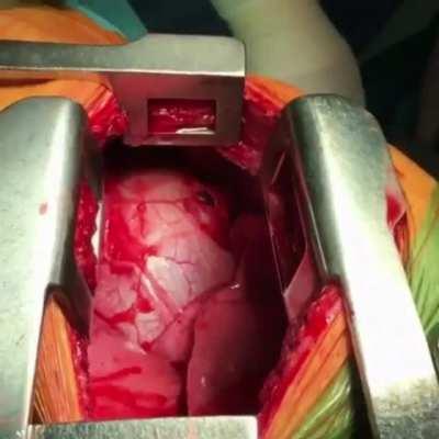 Doctors removing a knife that just missed the heart. It actually pierced the membrane of the heart wall. Very lucky. Warning: Open-heart surgery.