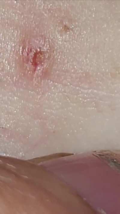 Curly ingrown 