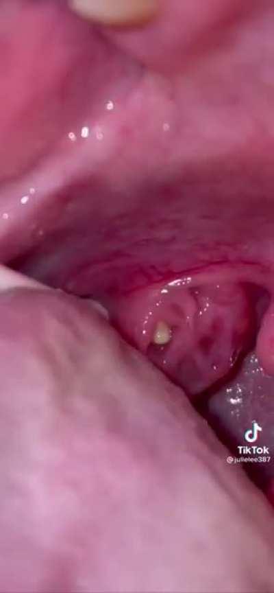 Tonsil holes