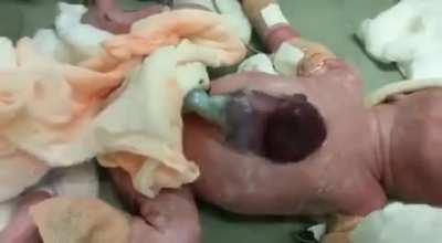 Newborn baby with Ectopia Cordis