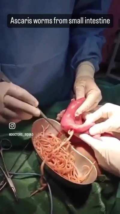 removal of worms (ascaris worms) from the intestine of a 6 year old child