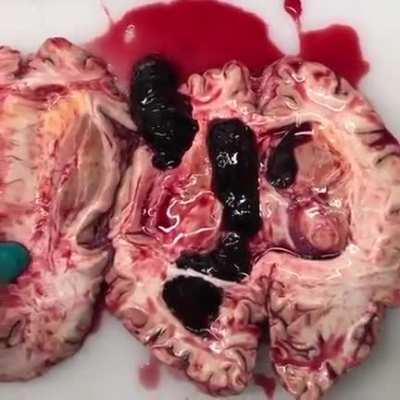 Blood clots in brain after haemorrhage 