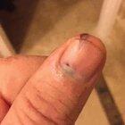 Bruise under nail